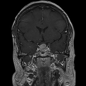 MRI מוח